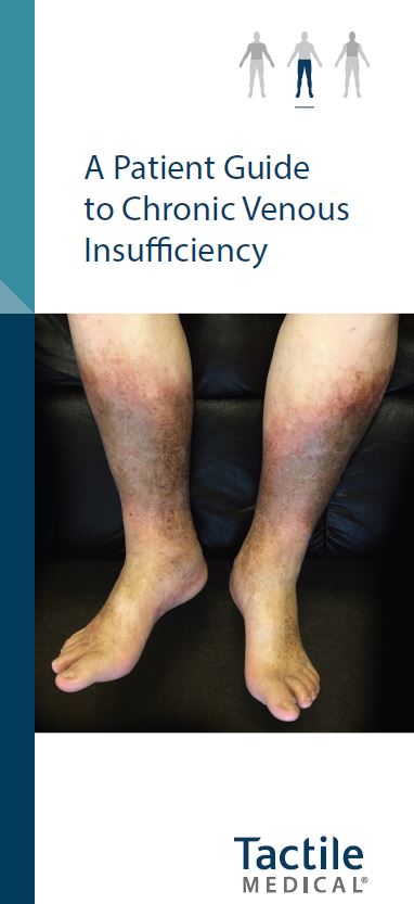 Patient Guide to Chronic Venous Insufficiency - Tactile Medical