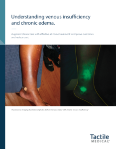 understanding venous insufficiency and chronic edema