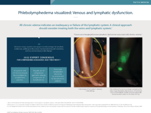 Phlebolymphedema - Chronic Edema - Visualized venous and lymphatic dysfunction