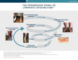 The Progressive Spiral of Lymphatic Dysfunction