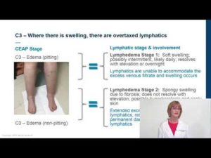 CVI Lymphatic Dysfunction: Today’s Evidence for Optimizing Treatment