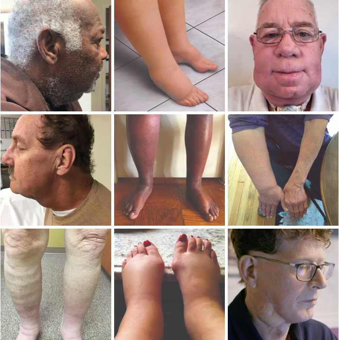 Images of Lymphedema