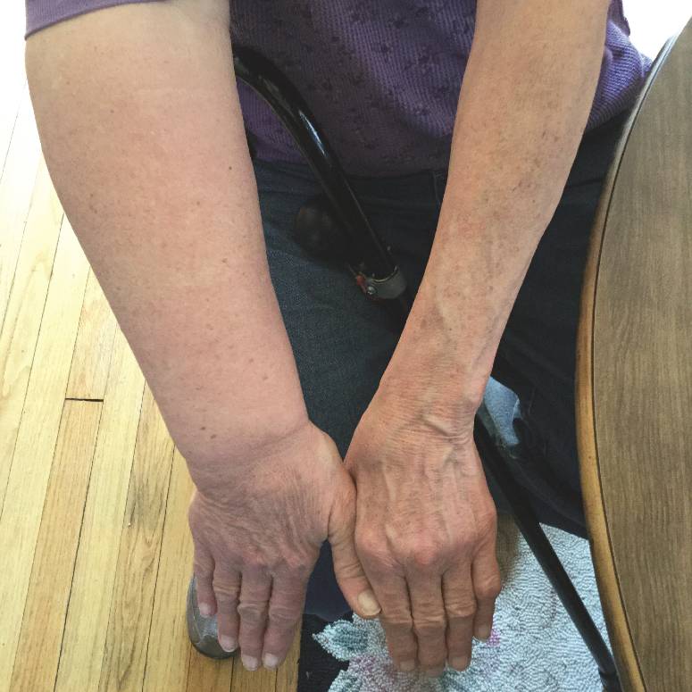 Lymphedema in the Arms
