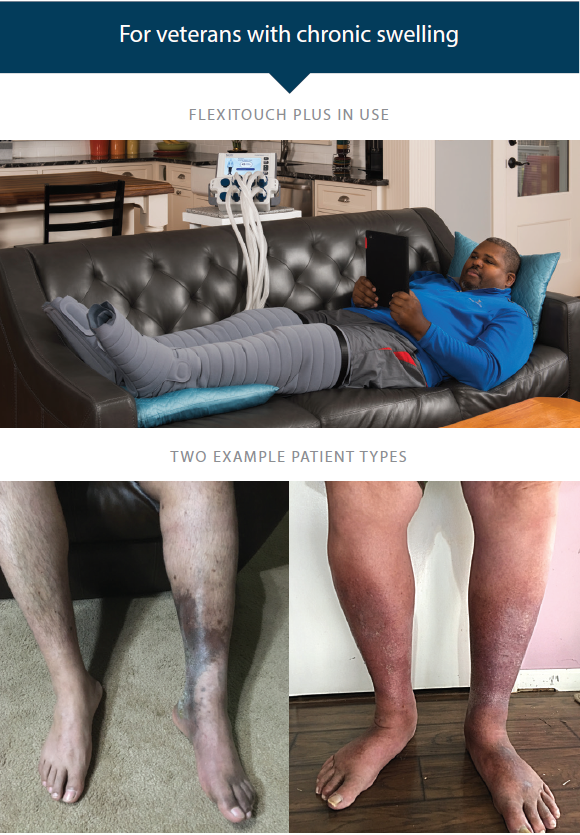veterans with lymphedema