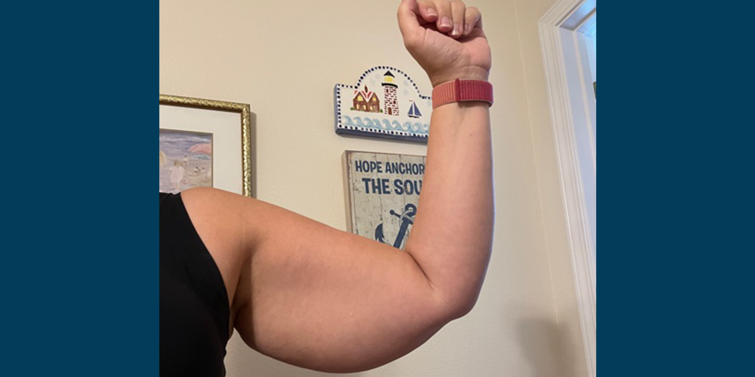 swollen arms from lipedema