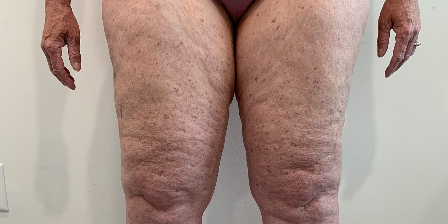 swollen thighs from lipedema