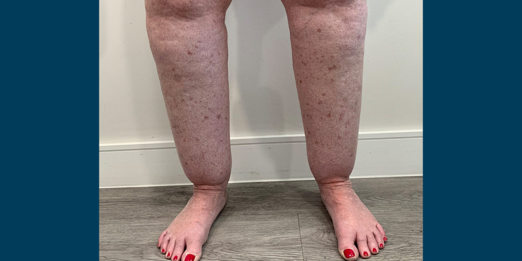 What Is Lipedema? Lipedema Causes & Treatments | Tactile Medical