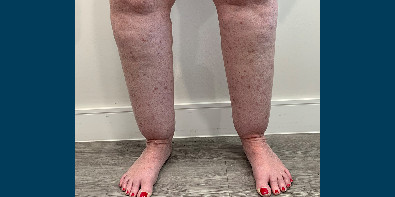 Lower Leg Swelling Caused by Lipedema