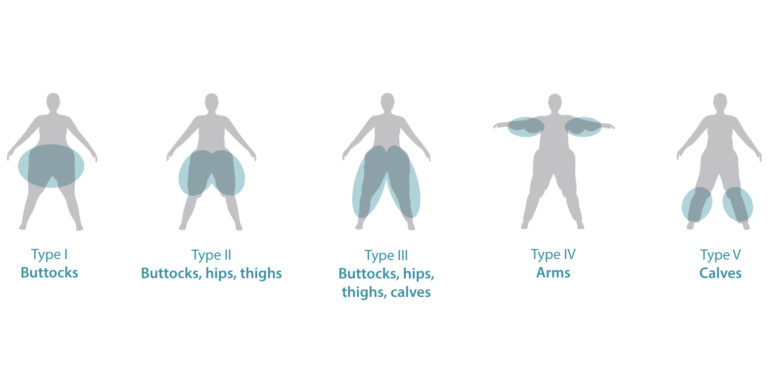 What Is Lipedema? Causes And Treatments Of Lymphedema | Tactile Medical