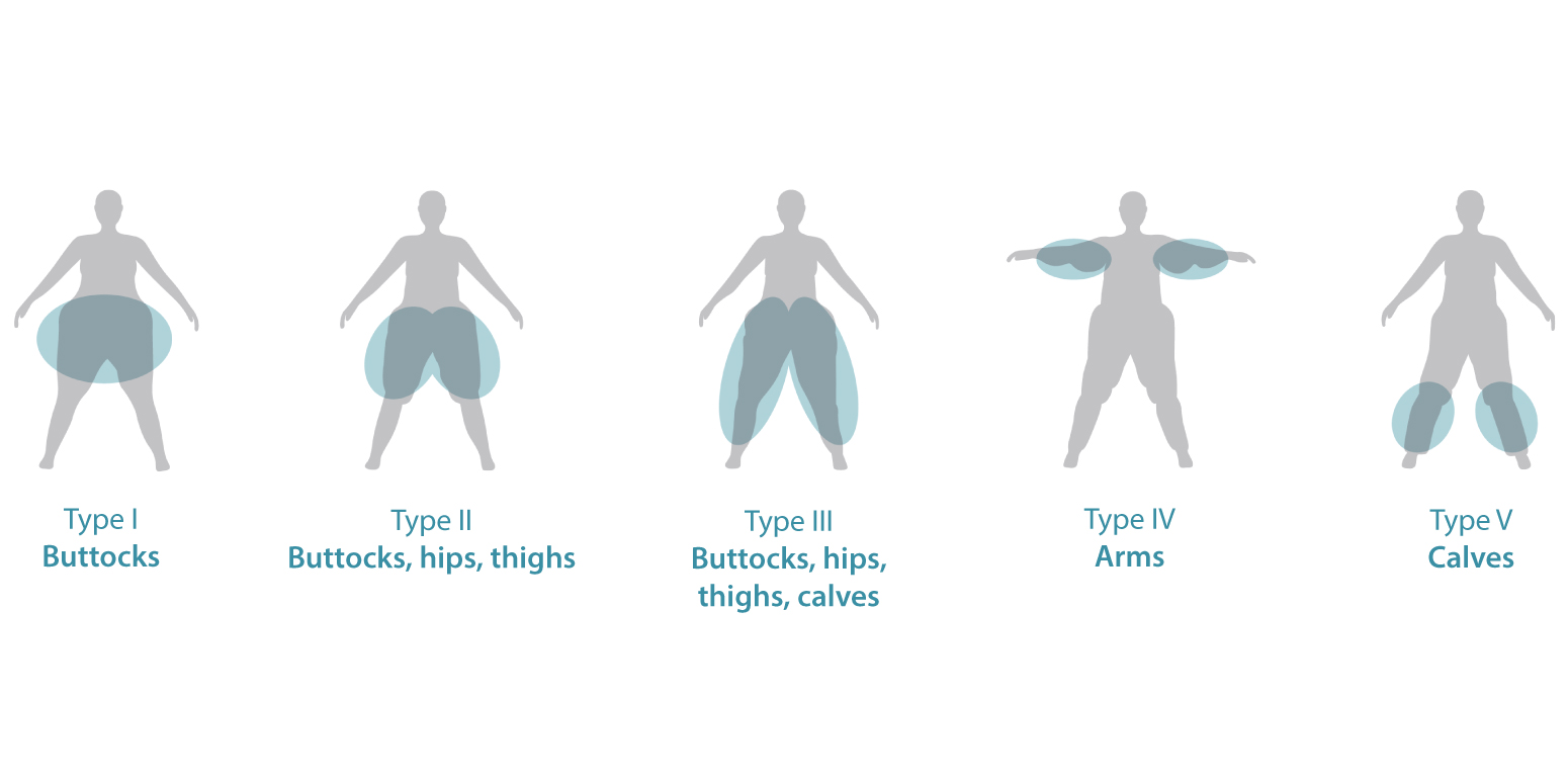 What Is Lipedema Lipedema Causes And Treatments Tactile Medical 