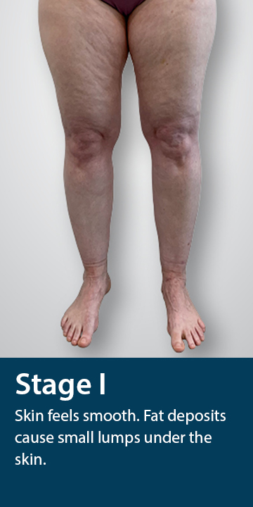 What Is Lipedema Lipedema Causes Treatments Tactile Medical