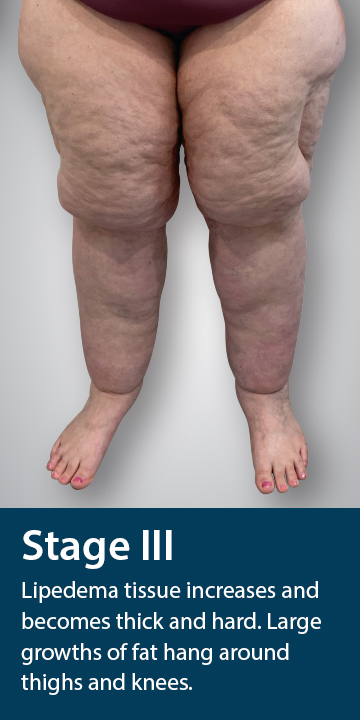Stage three of Lipedema - Lipedema tissue increases and becomes thick and hard. Large growth of fat hang around thighs and knees.