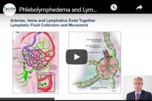 Phlebolymphedema and Lymphedema-Evaluation and Management