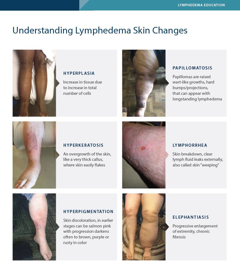 Understanding Lymphedema Skin Changes images