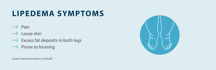 image showing lipedema symptoms