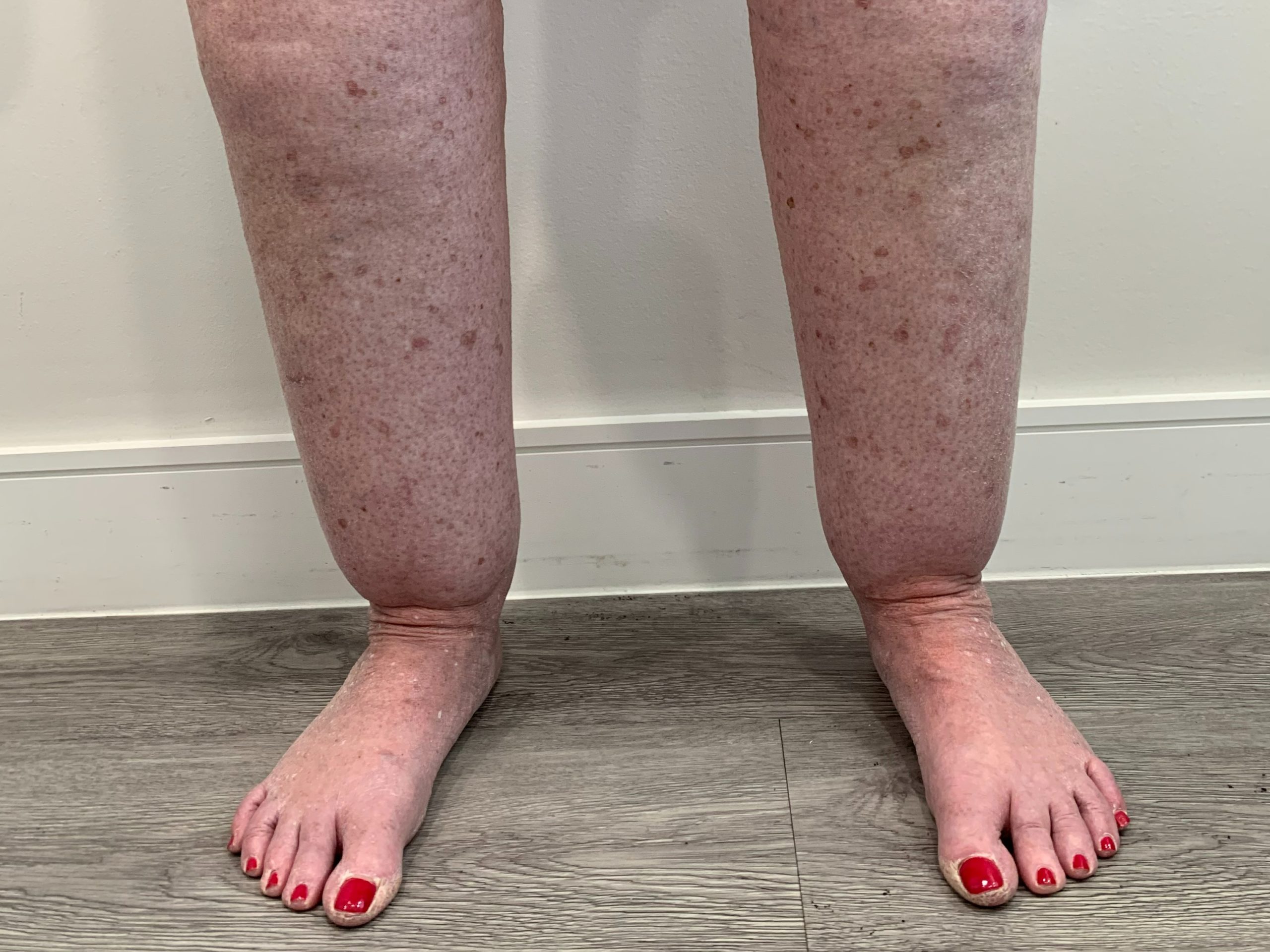 What you Need to Know About Lipedema
