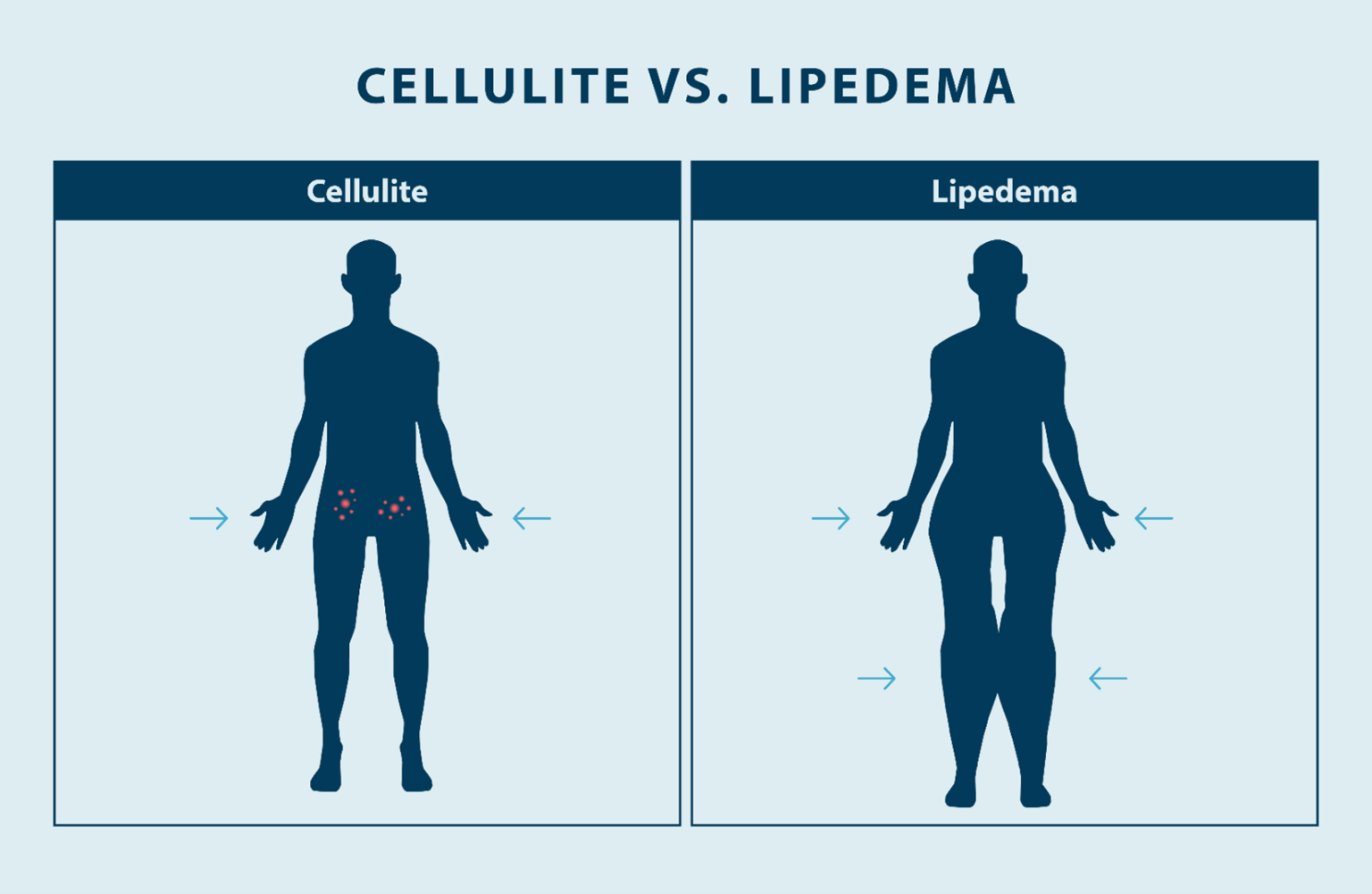 Lipedema Vs Cellulite What Are The Differences Tactil - vrogue.co