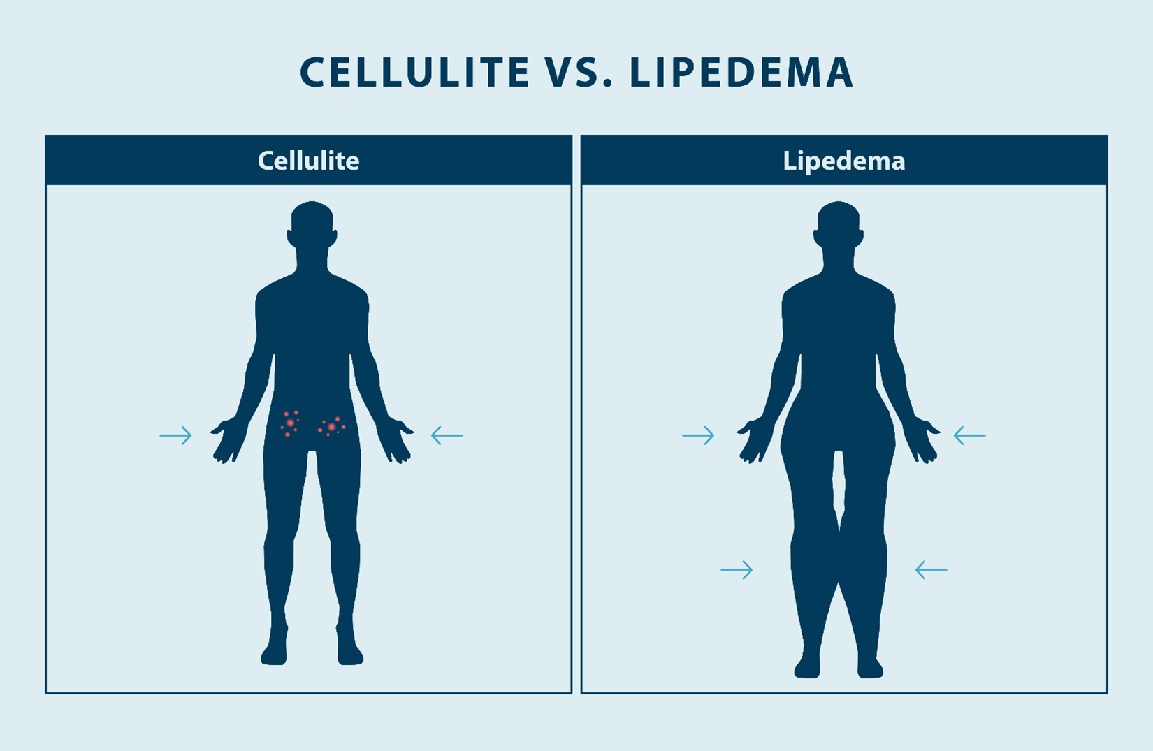 additional diagram of cellulitis versus lipedema