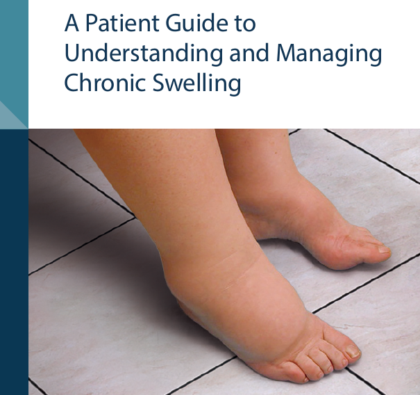 patient guide to understanding and managing chronic swelling article thumbnail