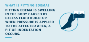 What Is Pitting Edema? - Tactile Medical