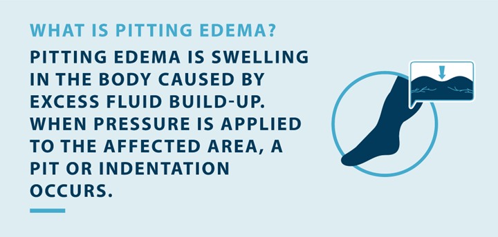 what is pitting edema; pitting edema is swelling in the body caused by excess fluid build-up. when pressure is applied to the affected area, a pit or indentation occurs