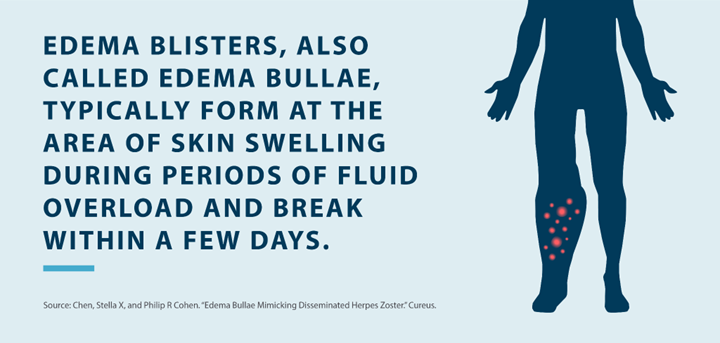 edema blisters also called edema bullae, typically form at the area of skin swelling during periods of fluid overload and break within a few days Source: Chen, Stella X, and Philip R Cohen