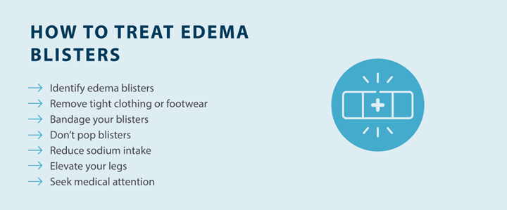how to treat edema blisters: identify edema blisters, remove tight clothing or footwear, bandage blisters, don't pop blisters, reduce sodium intake, elevate your legs, seek medical attention Source: Tactile Medical