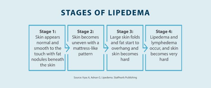 stages of lipedema