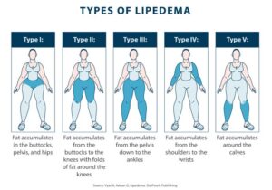 Lipedema Fibrosis: Everything You Need To Know - Tactile Medical