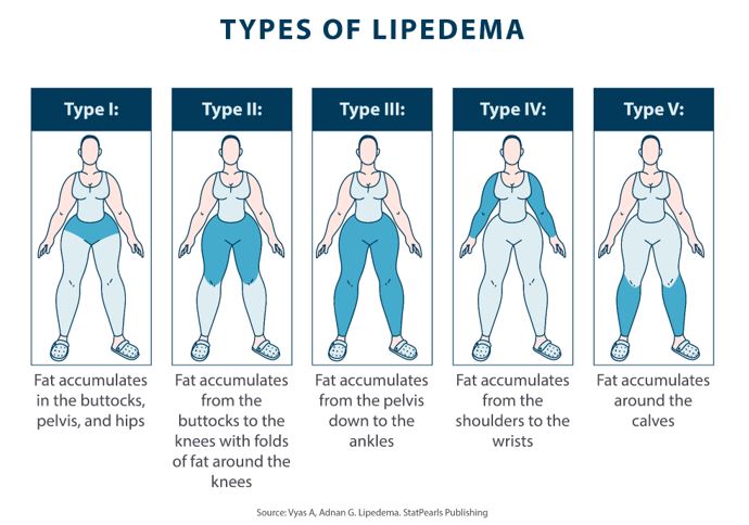 types of lipedema