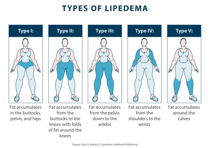 5 Types Of Lipedema Infoupdate