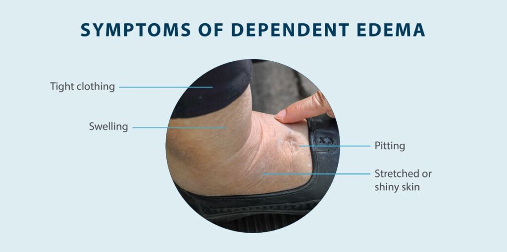 symptoms of dependent edema