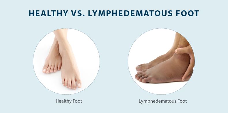 Healthy vs Lymphedematous Foot