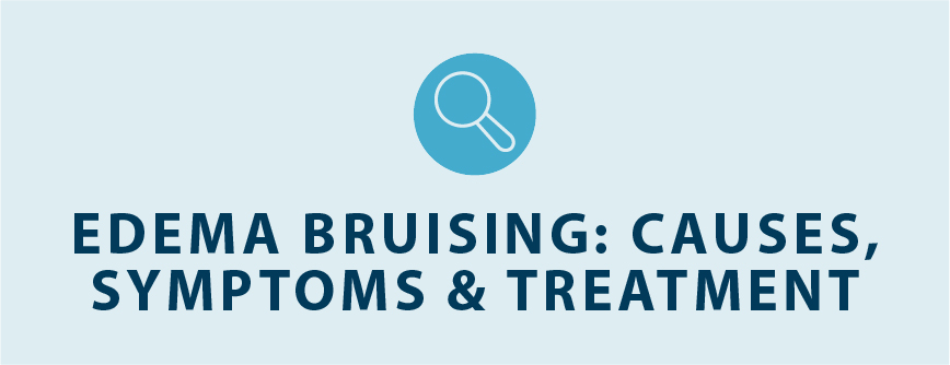 edema bruising causes symptoms and treatment