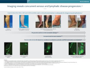 Progressive Skin and Lymphatic Dysfunction in Phlebolymphedema