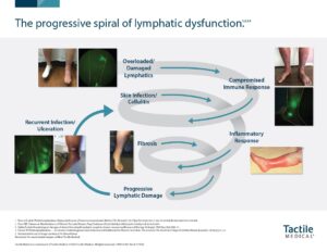 The Progressive Spiral of Lymphatic Dysfunction