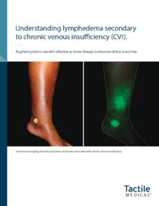 Venous Insufficiency and Chronic Edema Brochure