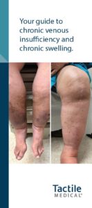 Patient Guide to Chronic Venous Insufficiency