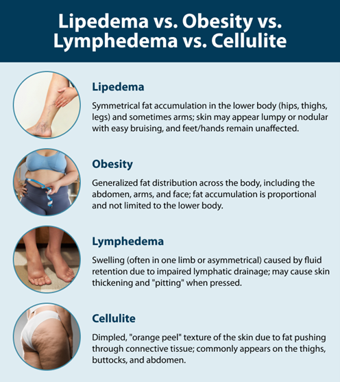 Lipedema vs. Obesity vs. Lymphedema vs. Cellulite Lipedema: Symmetrical fat accumulation in the lower body (hips, thighs, legs) and sometimes arms; skin may appear lumpy or nodular with easy bruising, and feet/hands remain unaffected. Obesity: Generalized fat distribution across the body, including the abdomen, arms, and face; fat accumulation is proportional and not limited to the lower body. Lymphedema: Swelling (often in one limb or asymmetrical) caused by fluid retention due to impaired lymphatic drainage; may cause skin thickening and "pitting" when pressed. Cellulite: Dimpled, "orange peel" texture of the skin due to fat pushing through connective tissue; commonly appears on the thighs, buttocks, and abdomen.