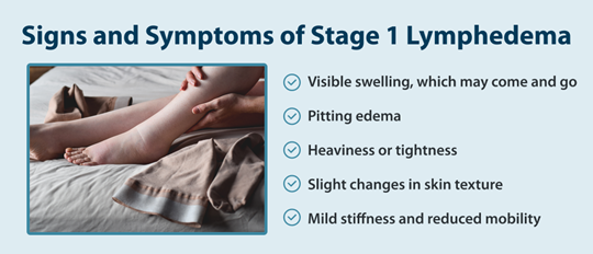 Signs and Symptoms of Stage 1 Lymphedema -Visible swelling, which may come and go -Pitting edema -Heaviness or tightness -Slight changes in skin texture -Mild stiffness and reduced mobility