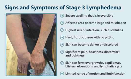 Signs and Symptoms of Stage 3 Lymphedema -Severe swelling that is irreversible -Affected area become large and misshapen -Highest risk of infection, such as cellulitis -Hard, fibrotic tissue with no pitting -Skin can become darker or discolored -Significant pain, heaviness, discomfort, and tightness -Skin can form overgrowths, papillomas, blisters, ulcerations, and lymphatic cysts -Limited range of motion and limb function