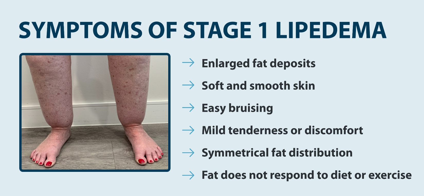 SYMPTOMS OF STAGE 1 LIPEDEMA —Enlarged fat deposits —Soft and smooth skin —Easy bruising -Mild tenderness or discomfort -Symmetrical fat distribution -Fat does not respond to diet or exercise