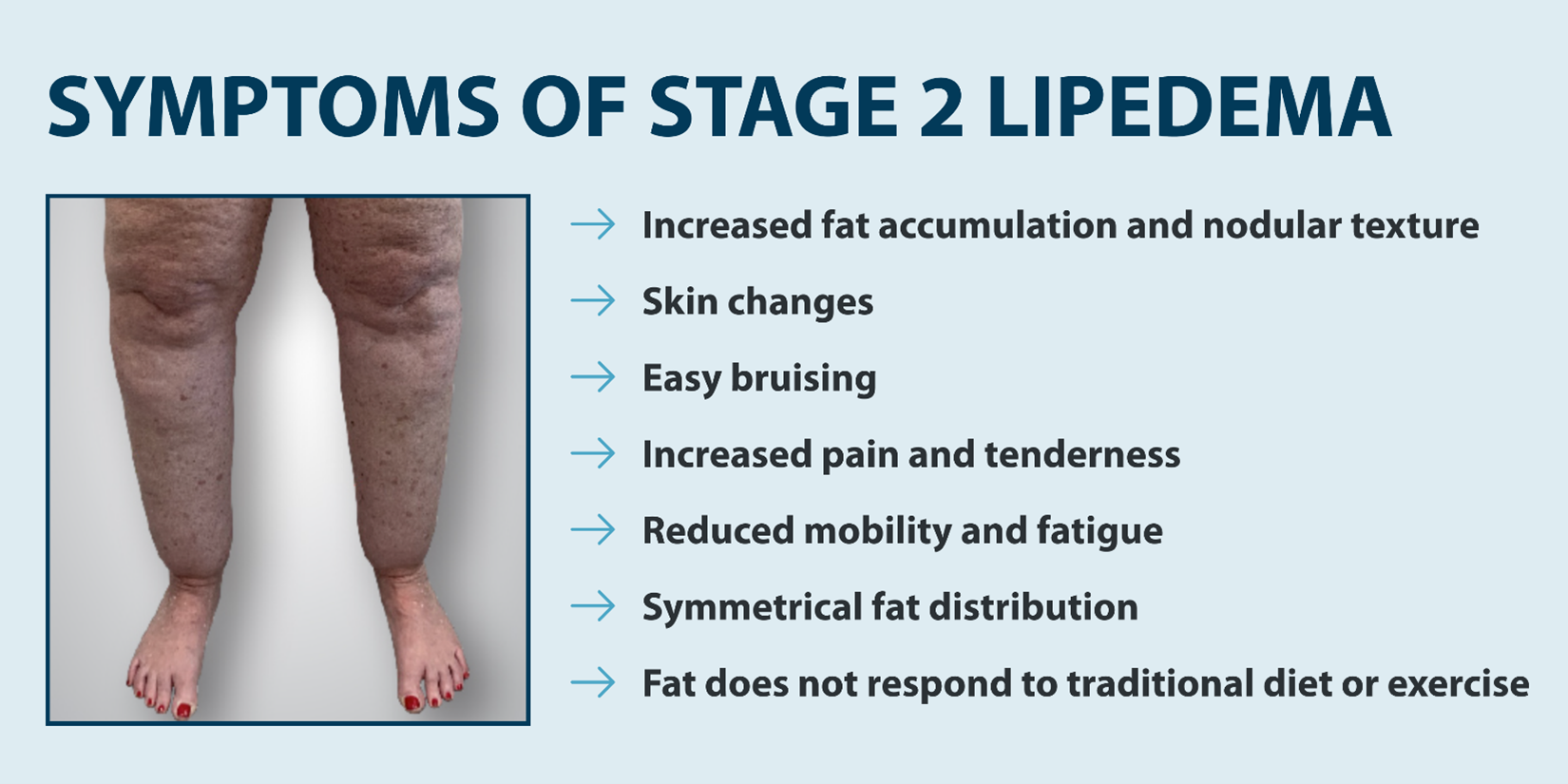 SYMPTOMS OF STAGE 2 LIPEDEMA -Increased fat accumulation and nodular texture -Skin changes -Easy bruising -Increased pain and tenderness -Reduced mobility and fatigue -Symmetrical fat distribution -Fat does not respond to traditional diet or exercise