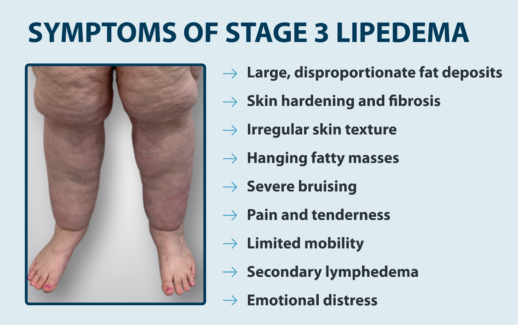 SYMPTOMS OF STAGE 3 LIPEDEMA -Large, disproportionate fat deposits -Skin hardening and fibrosis -Irregular skin texture -Hanging fatty masses -Severe bruising -Pain and tenderness -Limited mobility -Secondary lymphedema -Emotional distress
