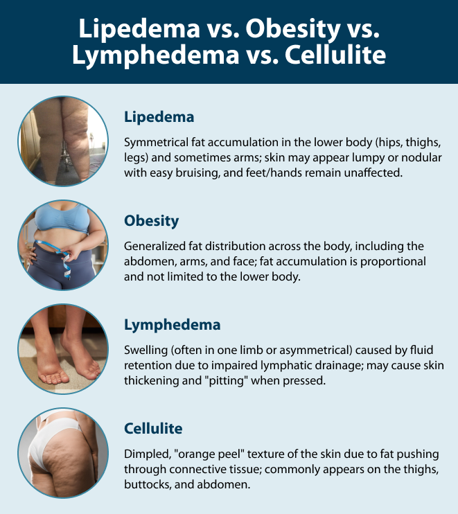 Lipedema vs. Obesity vs. Lymphedema vs. Cellulite Lipedema: Symmetrical fat accumulation in the lower body (hips, thighs, legs) and sometimes arms; skin may appear lumpy or nodular with easy bruising, and feet/hands remain unaffected. Obesity: Generalized fat distribution across the body, including the abdomen, arms, and face; fat accumulation is proportional and not limited to the lower body. Lymphedema: Swelling (often in one limb or asymmetrical) caused by fluid retention due to impaired lymphatic drainage; may cause skin thickening and "pitting" when pressed. Cellulite: Dimpled, "orange peel" texture of the skin due to fat pushing through connective tissue; commonly appears on the thighs, buttocks, and abdomen.