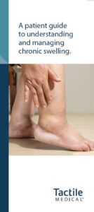 THUMBNAIL IMAGE - Chronic Swelling Patient Brochure_702003-001 Rev F