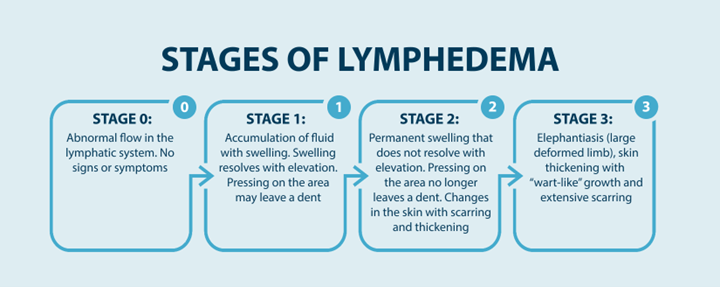 STAGES OF LYMPHEDEMA
Stage 0: abnormal flow in the lymphatic system. No signs or symptoms
Stage 1: Accumulation of fluid with swelling. Swelling resolves with elevation. Pressing on the area may leave a dent. 
Stage 2: Permanent swelling that does not resolve with elevation. Pressing on the area no longer leaves a dent. Changes in the skin with scarring and thickening. 
Stage 3: Elephantiasis (large deformed limb), skin thickening with "wart-like" growth and extensive scarring